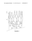 STENT WITH POLISHED EYELET diagram and image