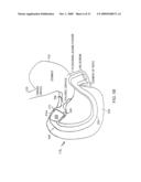 Bariatric sleeve diagram and image