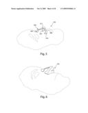 Nasal interface device diagram and image