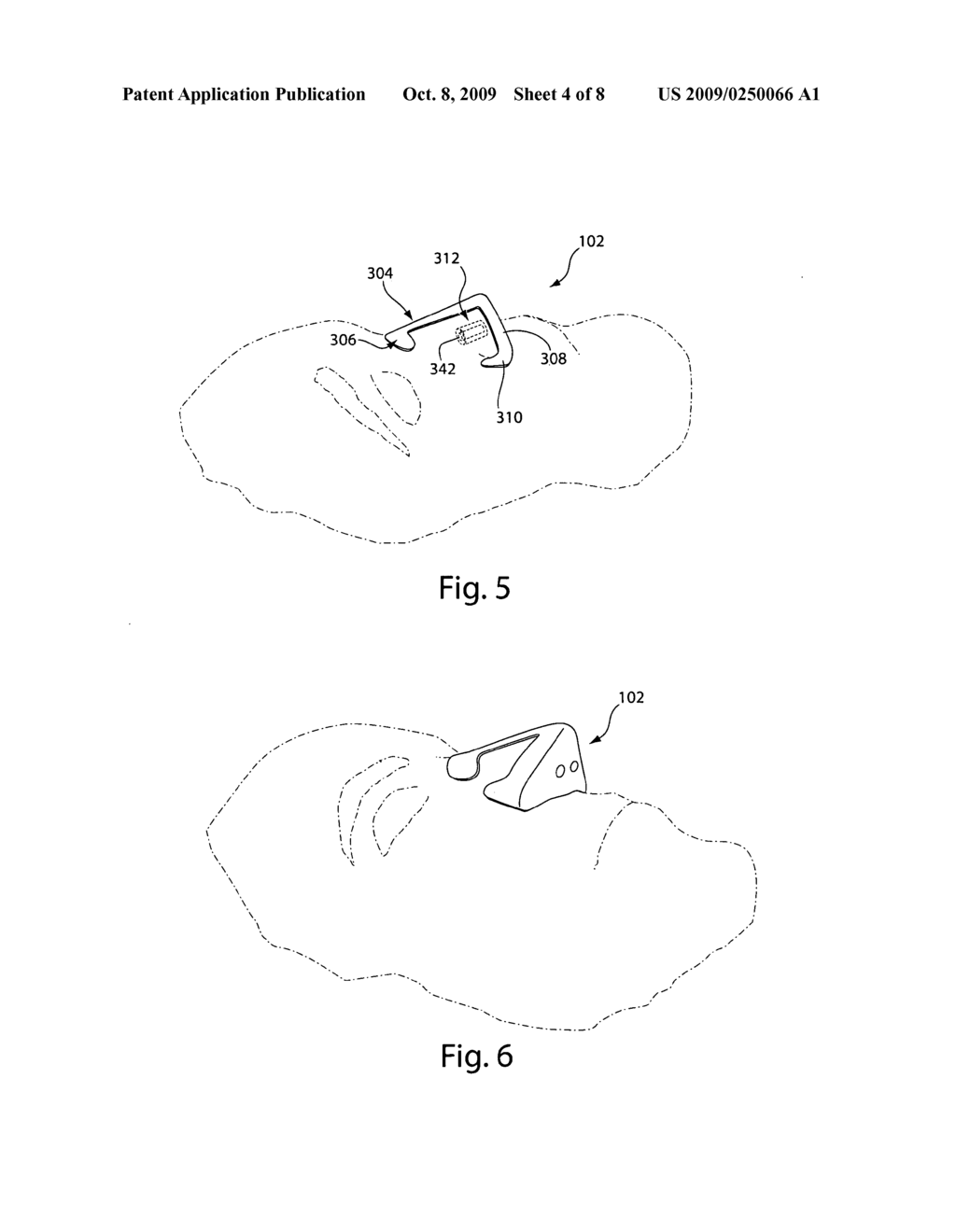 Nasal interface device - diagram, schematic, and image 05