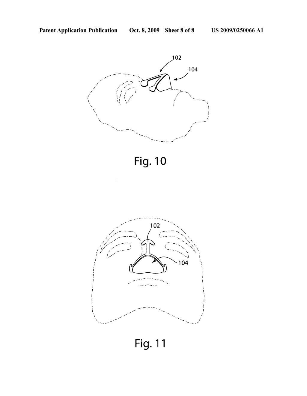 Nasal interface device - diagram, schematic, and image 09