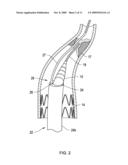 RETRIEVAL CATHETER AND METHODS OF RETRIEVING DEPLOYED MEDICAL DEVICES diagram and image