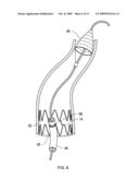 RETRIEVAL CATHETER AND METHODS OF RETRIEVING DEPLOYED MEDICAL DEVICES diagram and image