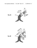 Venous Filter with Detachable Anchors diagram and image