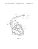 Temperature Based Systems and Methods for Tachycardia Discrimination and Therapy diagram and image