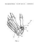 System and method for trapezium bone replacement diagram and image