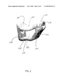 System and method for trapezium bone replacement diagram and image