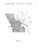 System and method for trapezium bone replacement diagram and image