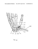 System and method for trapezium bone replacement diagram and image