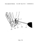 System and method for trapezium bone replacement diagram and image