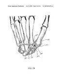 System and method for trapezium bone replacement diagram and image