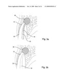 Method of Treating Dental Periapical Lesions diagram and image