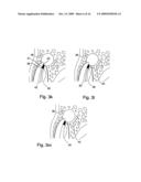 Method of Treating Dental Periapical Lesions diagram and image