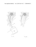 Method of Treating Dental Periapical Lesions diagram and image