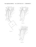 Method of Treating Dental Periapical Lesions diagram and image