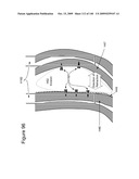 METHODS AND DEVICES TO DECREASE TISSUE TRAUMA DURING SURGERY diagram and image