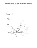 METHODS AND DEVICES TO DECREASE TISSUE TRAUMA DURING SURGERY diagram and image