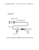 METHODS AND DEVICES TO DECREASE TISSUE TRAUMA DURING SURGERY diagram and image