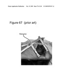 METHODS AND DEVICES TO DECREASE TISSUE TRAUMA DURING SURGERY diagram and image