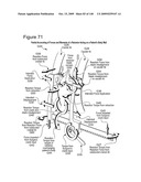 METHODS AND DEVICES TO DECREASE TISSUE TRAUMA DURING SURGERY diagram and image