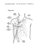 METHODS AND DEVICES TO DECREASE TISSUE TRAUMA DURING SURGERY diagram and image