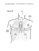 METHODS AND DEVICES TO DECREASE TISSUE TRAUMA DURING SURGERY diagram and image