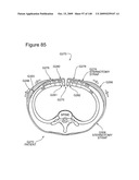 METHODS AND DEVICES TO DECREASE TISSUE TRAUMA DURING SURGERY diagram and image