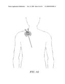 DIALYSIS CATHETER ANCHORING SYSTEM diagram and image