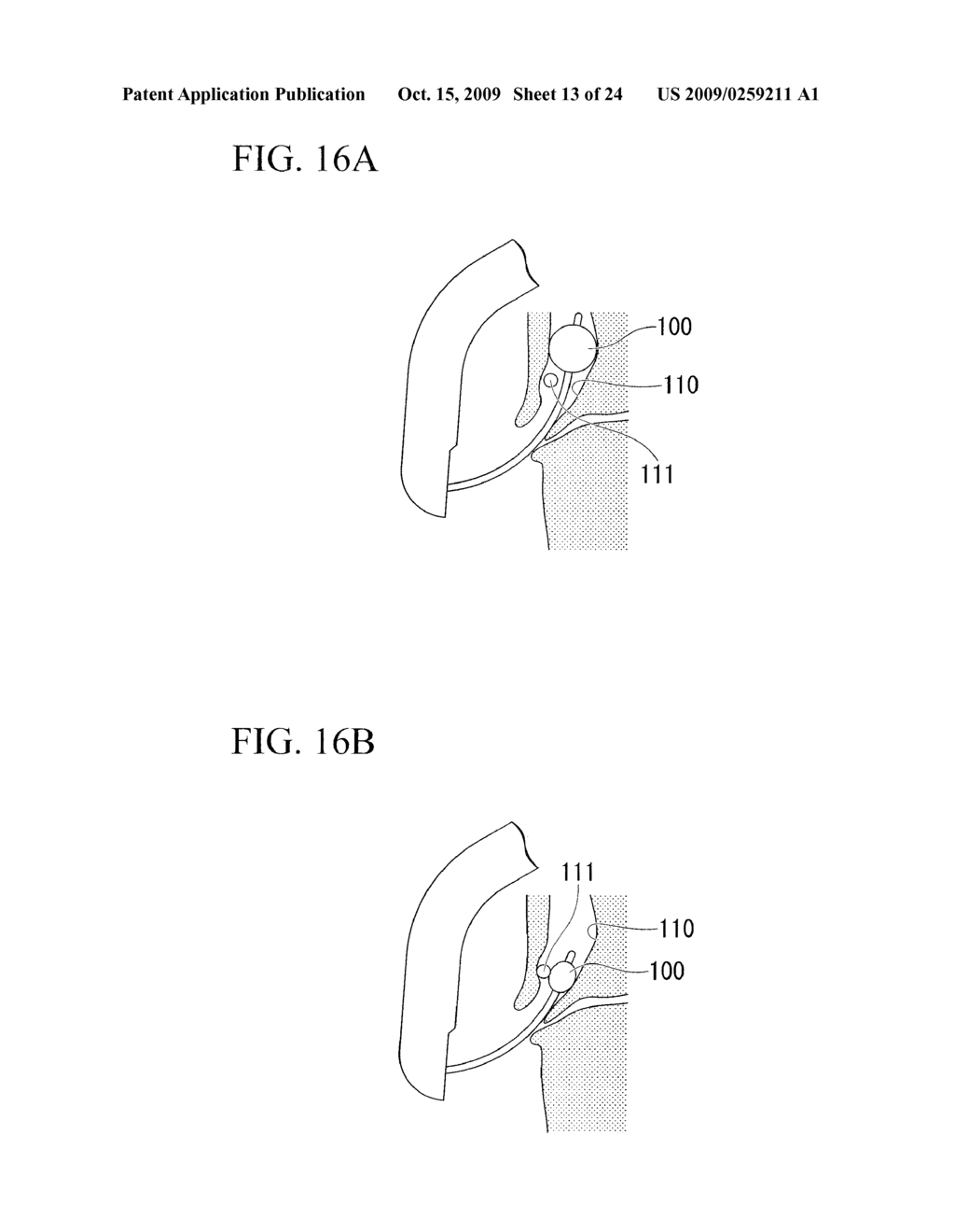 FLUID FEEDER, BALLOON CATHETER AND FLUID FEEDER SUPPORTING DEVICE - diagram, schematic, and image 14