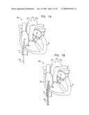 SEGMENTED RING PLACEMENT diagram and image