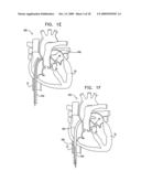 SEGMENTED RING PLACEMENT diagram and image