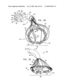 SEGMENTED RING PLACEMENT diagram and image