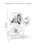 SEGMENTED RING PLACEMENT diagram and image