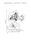 SEGMENTED RING PLACEMENT diagram and image