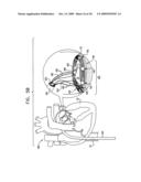 SEGMENTED RING PLACEMENT diagram and image