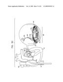 SEGMENTED RING PLACEMENT diagram and image