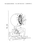 SEGMENTED RING PLACEMENT diagram and image