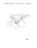 FLUID PUMPING DEVICE AND COMPONENTS WITH STATIC SEAL diagram and image