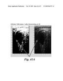 SYSTEM AND METHOD FOR BLADDER DETECTION USING HARMONIC IMAGING diagram and image