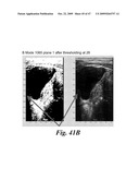 SYSTEM AND METHOD FOR BLADDER DETECTION USING HARMONIC IMAGING diagram and image