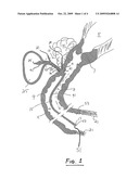 Biliary/Pancreatic Shunt Device and Method for Treatment of Metabolic and Other Diseases diagram and image