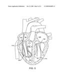 Catheter Having a Selectively Expandable Distal Tip diagram and image