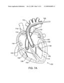 Catheter Having a Selectively Expandable Distal Tip diagram and image