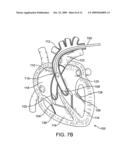 Catheter Having a Selectively Expandable Distal Tip diagram and image