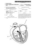 Device, A Kit And A Method For Treatment Of Disorders In The Heart Rhythm Regulation System diagram and image