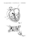 Device, A Kit And A Method For Treatment Of Disorders In The Heart Rhythm Regulation System diagram and image