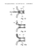 Device, A Kit And A Method For Treatment Of Disorders In The Heart Rhythm Regulation System diagram and image