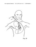 Device, A Kit And A Method For Treatment Of Disorders In The Heart Rhythm Regulation System diagram and image