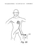 Device, A Kit And A Method For Treatment Of Disorders In The Heart Rhythm Regulation System diagram and image