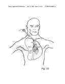 Device, A Kit And A Method For Treatment Of Disorders In The Heart Rhythm Regulation System diagram and image